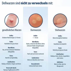 Evolsin Dellwarzen Mittel Lösung, 5 ml><noscript><img width=