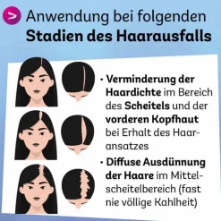 Dexcel Minoxidil 20 mg / ml Spray z.Anw.a.d.Kopfhaut, 60 ml><noscript><img width=