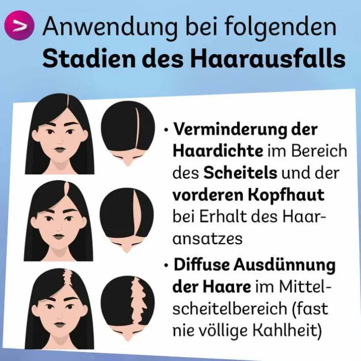 Dexcel Minoxidil 20 mg / ml Spray z.Anw.a.d.Kopfhaut, 60 ml> Mittel Gegen Haarausfall