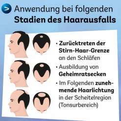 Minoxidil Dexcel 50 mg / ml Spray z.Anw.a.d.Kopfhaut, 3X60 ml